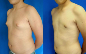 Воспалилась молочная железа у мальчика