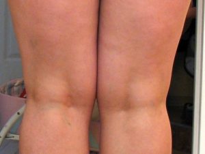 Отек внутренней стороны бедра и варикоз