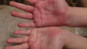 Опухла, покраснела, чешится и болит рука