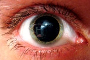 Глаз тровмирован, зрачок расширен, плохо реагирует на свет