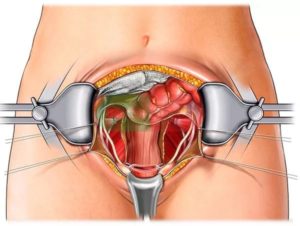 Операция по удалению матки болит низ живота после физической нагрузки