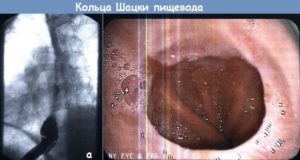 Кольцо Шацкого