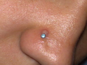 Образование шишки на месте прокола носа