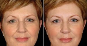 Сколько процедур ЛИТ потребуется