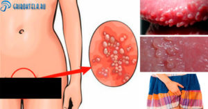 Какие инфекции можно занести во влагалище грязными руками