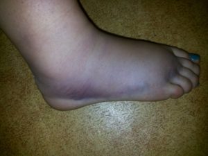 Травма голени не проходит отек