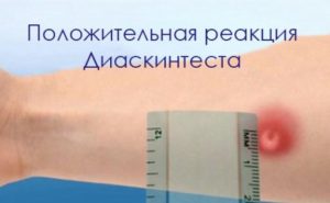 Сделали диаскинтест оказался положительный при том что все анализы хорошие