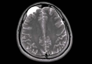Арахноидальные изменения ликворокистозного характера