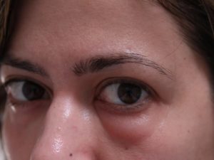 Отек левый глаз