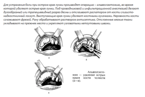 Острый край после удаления