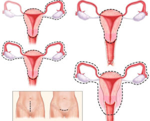 Климакс после удаления матки