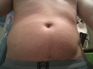 Твердый живот справа возле пупка и внизу