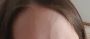 Вздутие вен на лбу