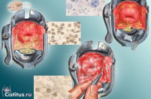 Кровяные выделения и струп после конизации шейки