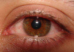 Красный глаз и опух. Порвалась линза в глазу
