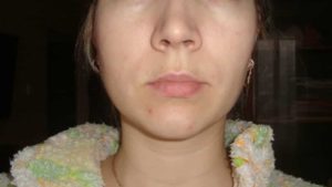 Шишка у зуба мудрости