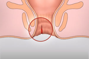 Зуд во влагалище и области ануса