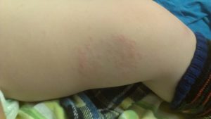 Сыпь на бедре у ребёнка