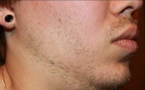 Плохо растут волосы на теле