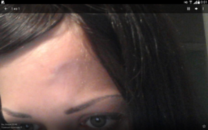 Вздутие вен на лбу