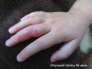 Опухла, покраснела, чешится и болит рука