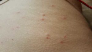 Мелкие красные прыщи на теле и чешутся