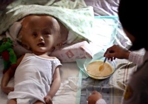 Большая голова у плода