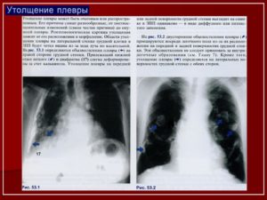 Утолщение плевры