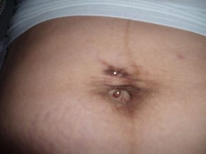 Боль в пупке после родов