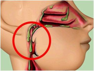 Стекает гной по носоглотке