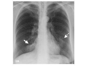 Утолщение плевры