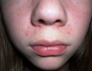 Прыщи возле носа у ребенка