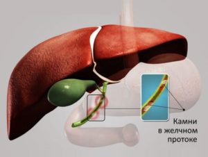 Холецистит, застой желчи, сладж в пузыре