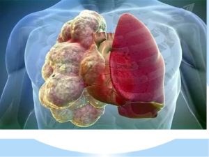 Плеврэктомия при буллезной эмфиземе