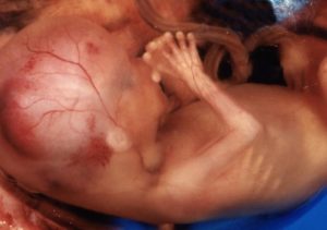 Замершая беременность 15-16 недель