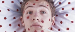 Алкоголь при ветрянке на 12 день