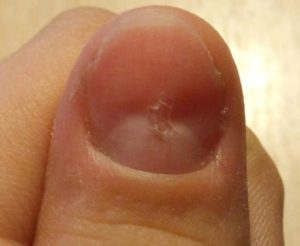 Перепилили ноготь до мяса около кутикулы образовалась дырка