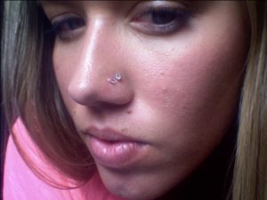 Образование шишки на месте прокола носа