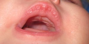 Белое пятнышко у ребенка на нёбе