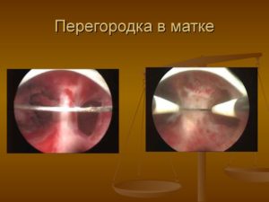 Перегородка в матке