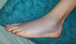 Травма голени не проходит отек