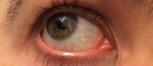 Желеобразное образование на белке глаза