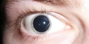 Глаз тровмирован, зрачок расширен, плохо реагирует на свет