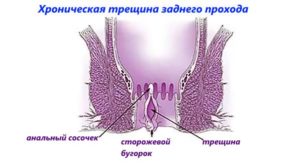Сторожевой бугорок