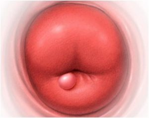 Твердый шарик на шейке маткт