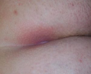 Прыщи на копчике