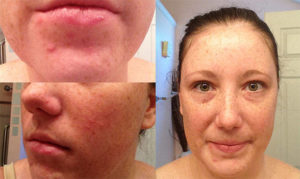 Прыщи от дюфастона