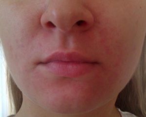 Красные пятна вокруг рта