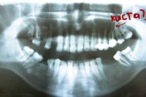 Образование на нижней челюсти