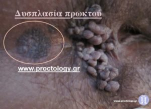 Нарост около анального размера немаленького размера